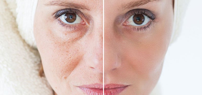 Les avantages du peeling du visage